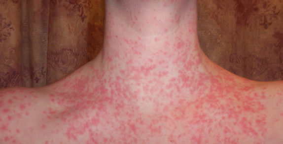 guttate-psoriasis-symptoms